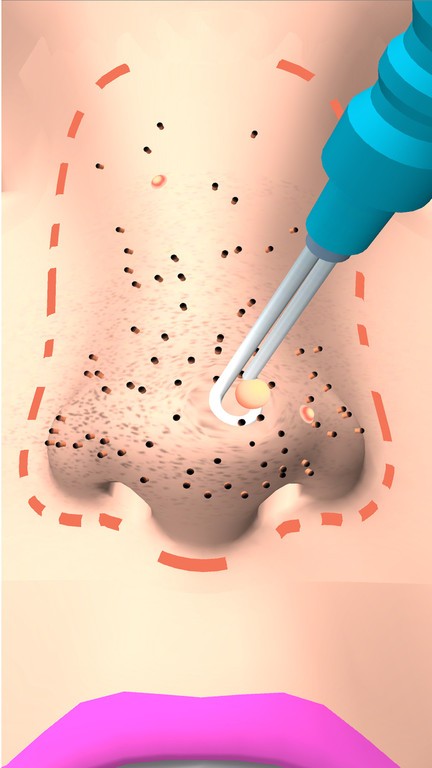挤黑头大师截图欣赏